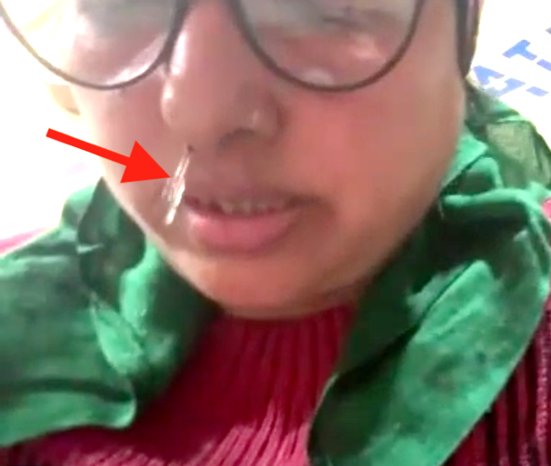 Amazing recovery in a case of CSF Rhinorrhea from Delhi